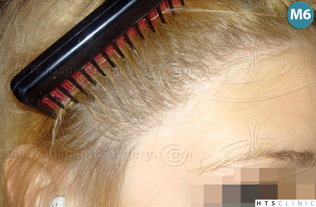 Dr.Devroye-HTS-Clinic-2693-FUT-Female-Traction-Alopecia-21.jpg