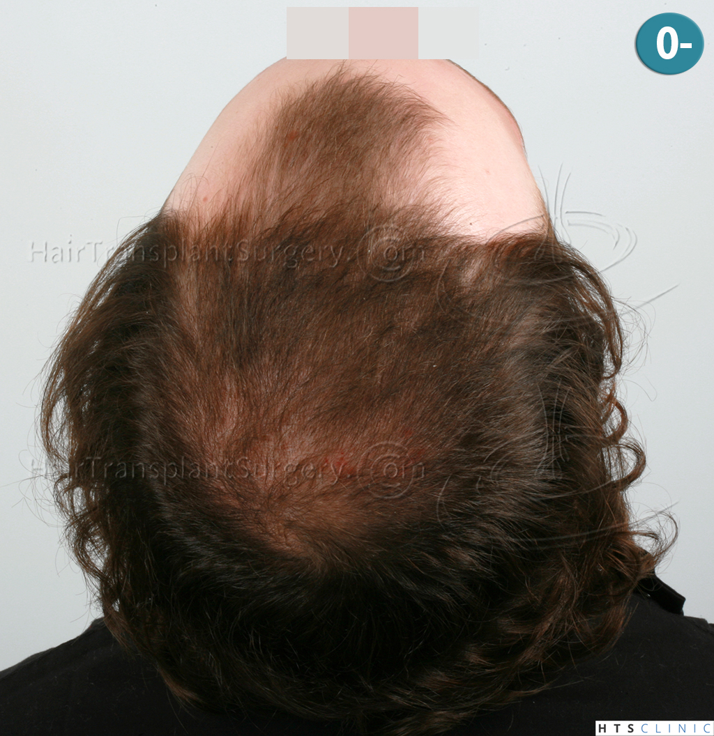 Dr.Devroye-HTS-Clinic-6103FUT_3722_2381_-NW-IV-6.jpg
