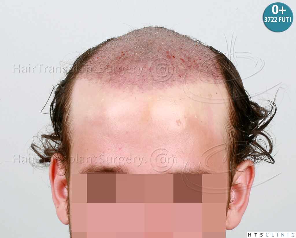 Dr.Devroye-HTS-Clinic-6103FUT_3722_2381_-NW-IV-9.jpg