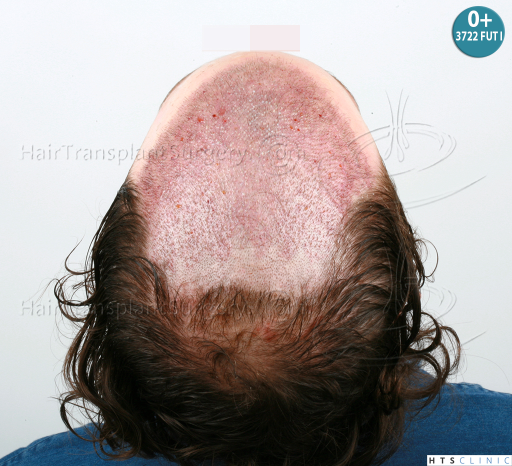 Dr.Devroye-HTS-Clinic-6103FUT_3722_2381_-NW-IV-12.jpg