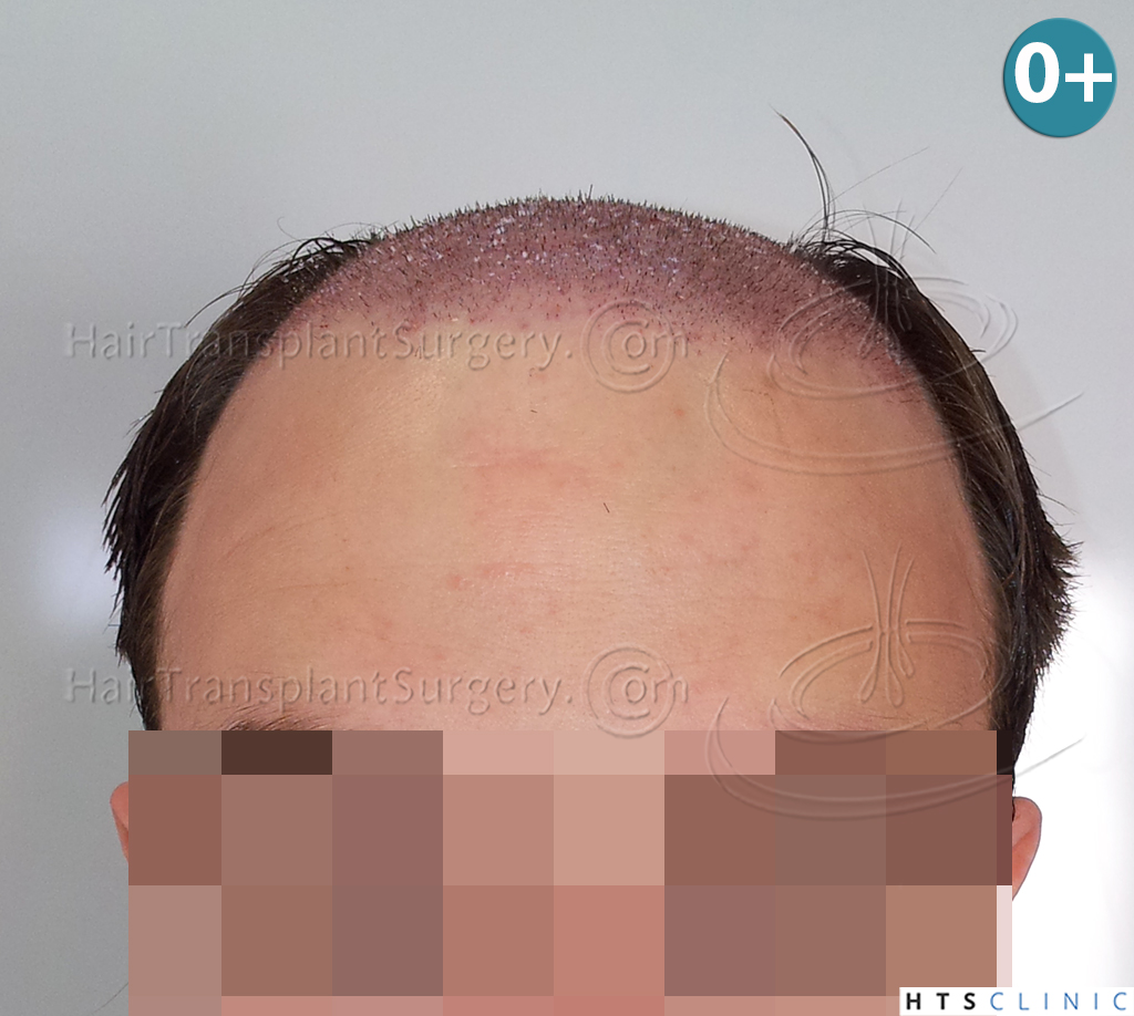 Dr.Devroye-HTS-Clinic-3856-FUT-NW-IV-5.jpg
