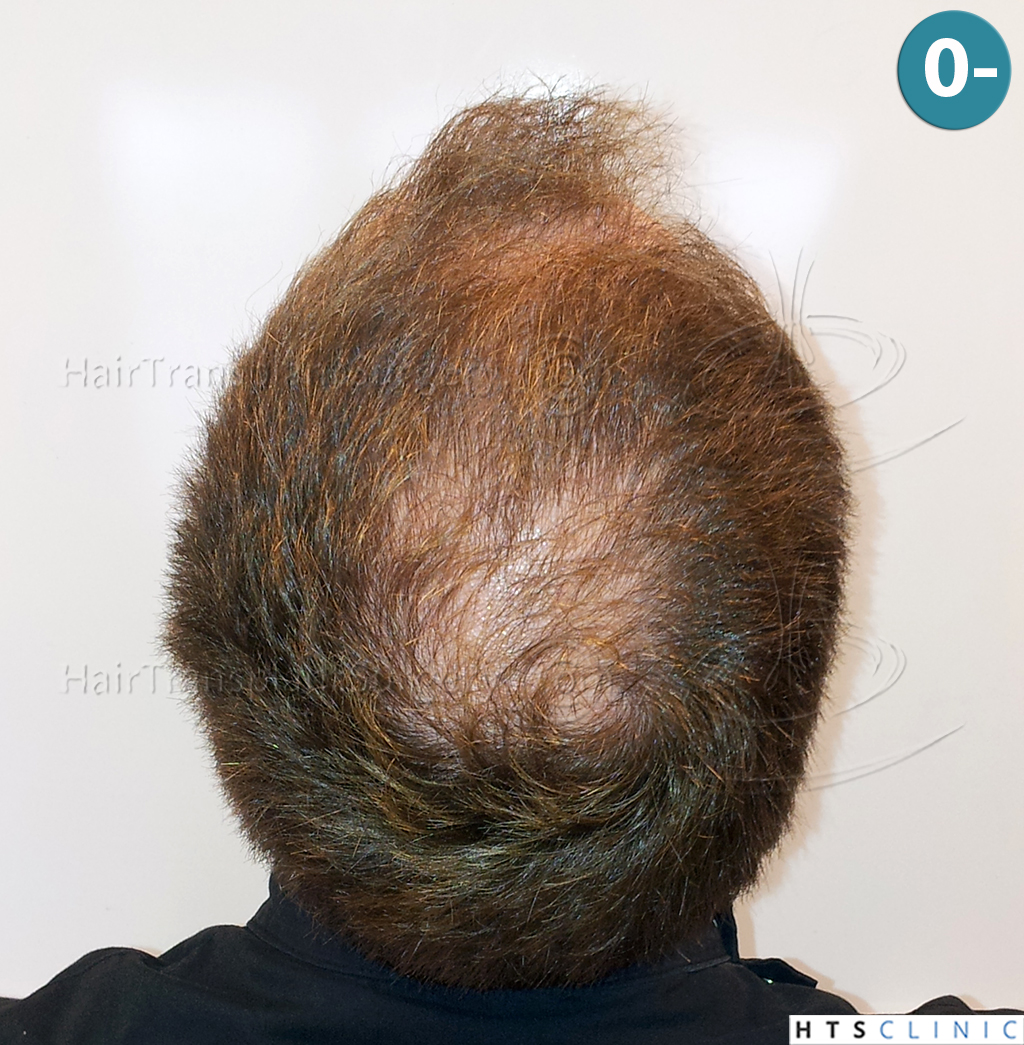 Dr.Devroye-HTS-Clinic-3856-FUT-NW-IV-4.jpg
