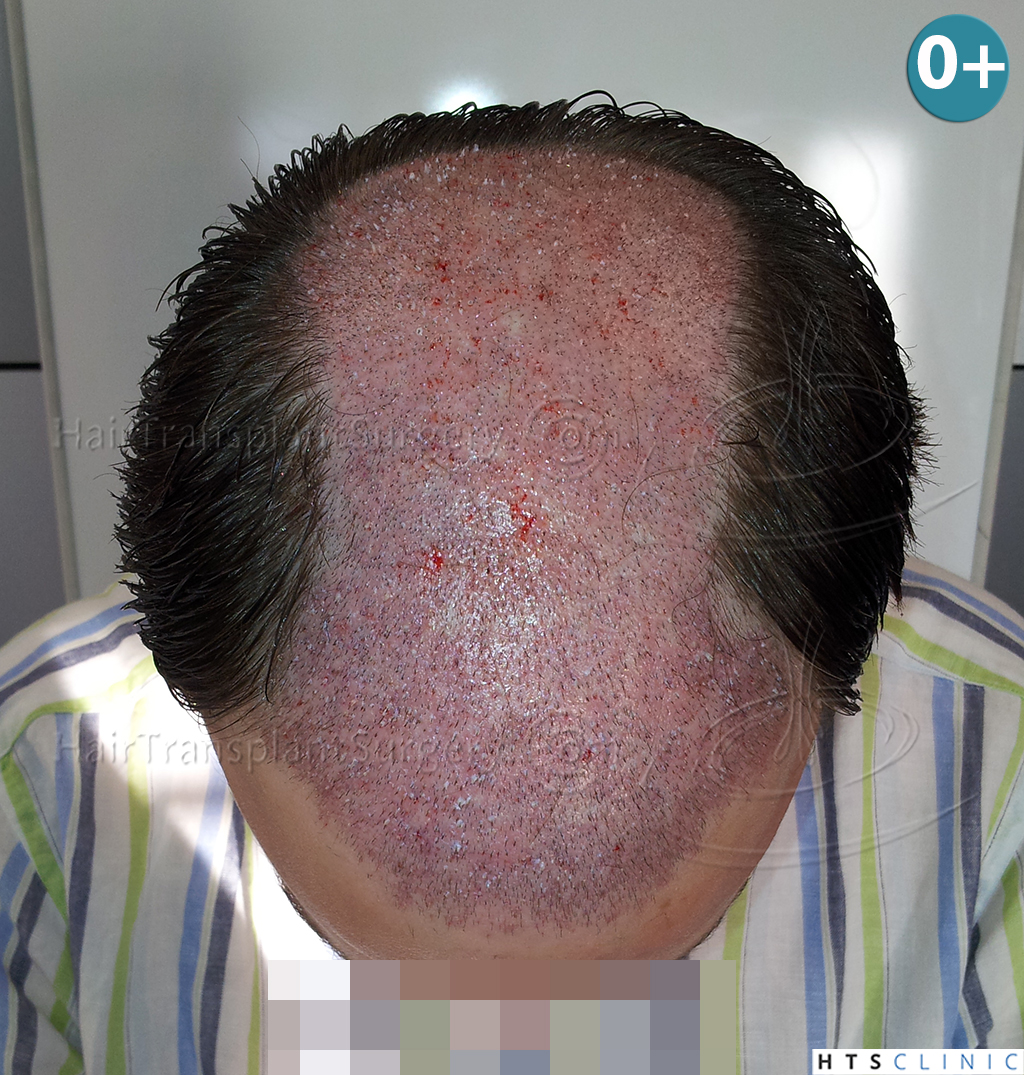 Dr.Devroye-HTS-Clinic-3856-FUT-NW-IV-6.jpg