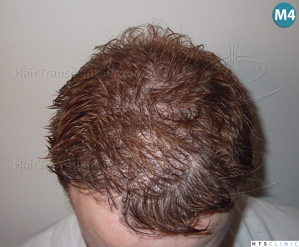 Dr.Devroye-HTS-Clinic-3856-FUT-NW-IV-10.jpg