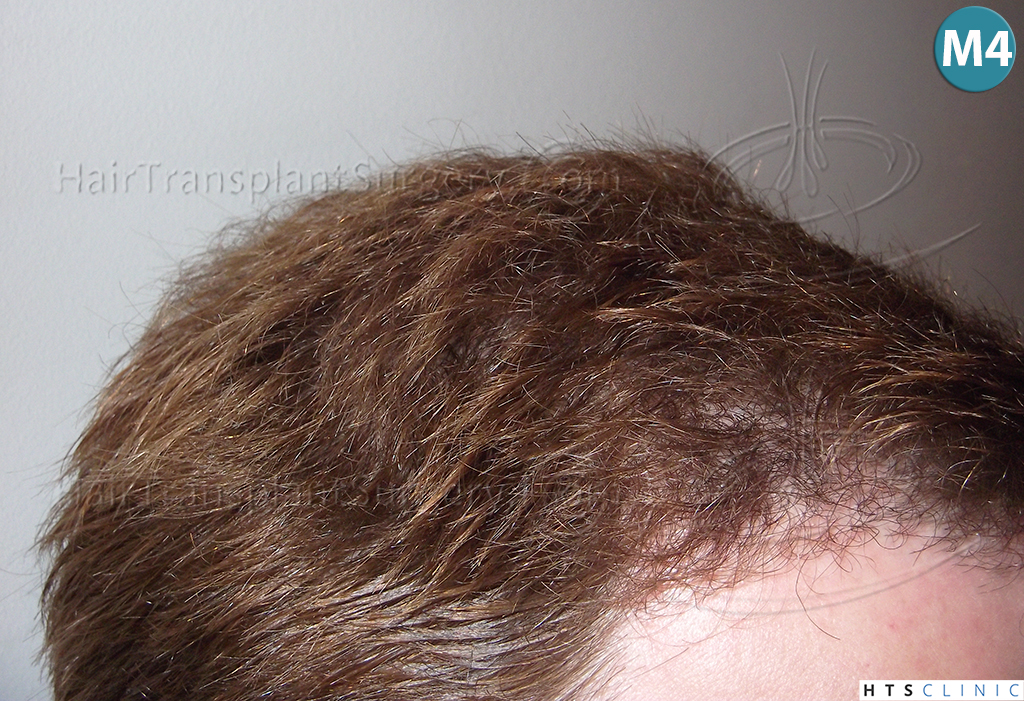 Dr.Devroye-HTS-Clinic-3856-FUT-NW-IV-11.jpg