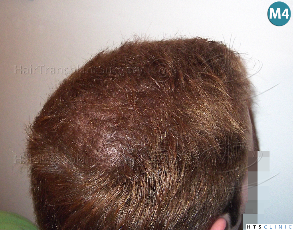 Dr.Devroye-HTS-Clinic-3856-FUT-NW-IV-12.jpg