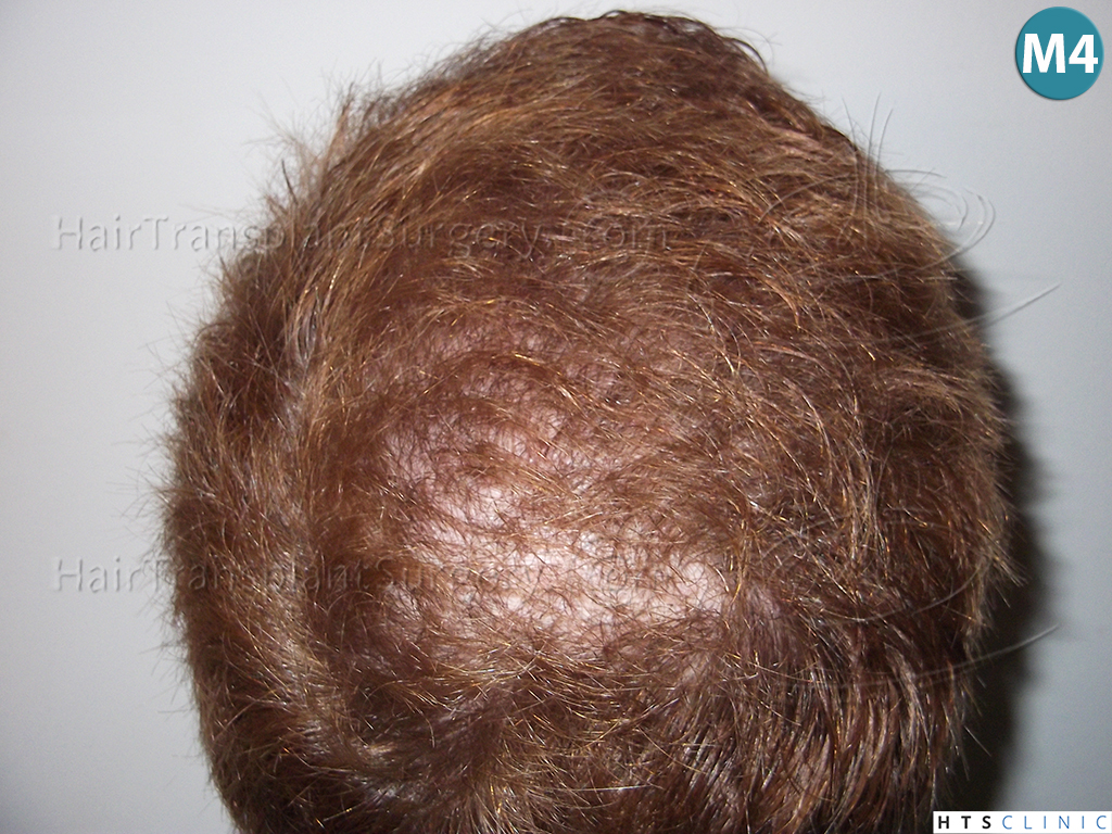 Dr.Devroye-HTS-Clinic-3856-FUT-NW-IV-14.jpg