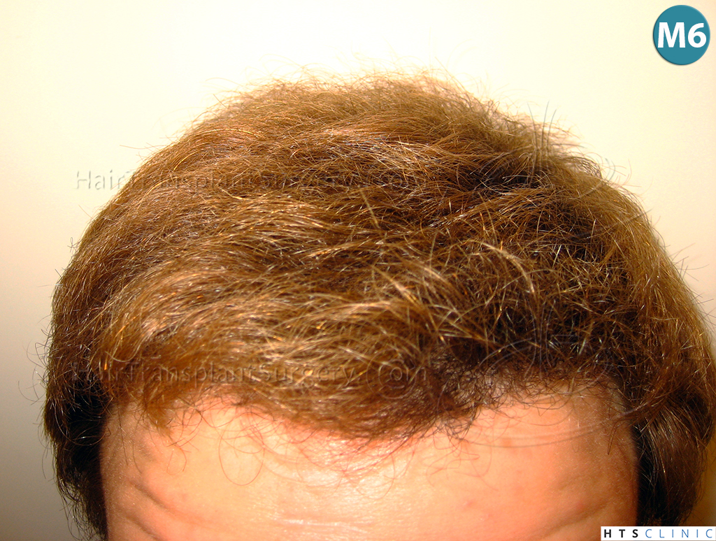 Dr.Devroye-HTS-Clinic-3856-FUT-NW-IV-15.jpg