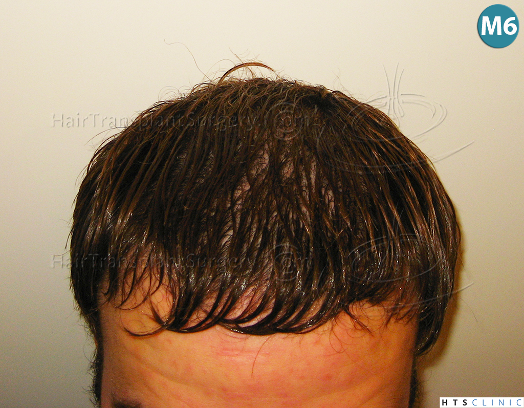 Dr.Devroye-HTS-Clinic-3856-FUT-NW-IV-16.jpg