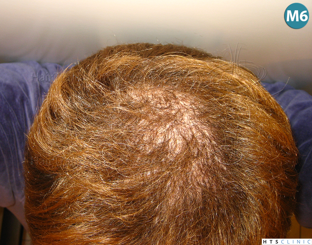 Dr.Devroye-HTS-Clinic-3856-FUT-NW-IV-20.jpg