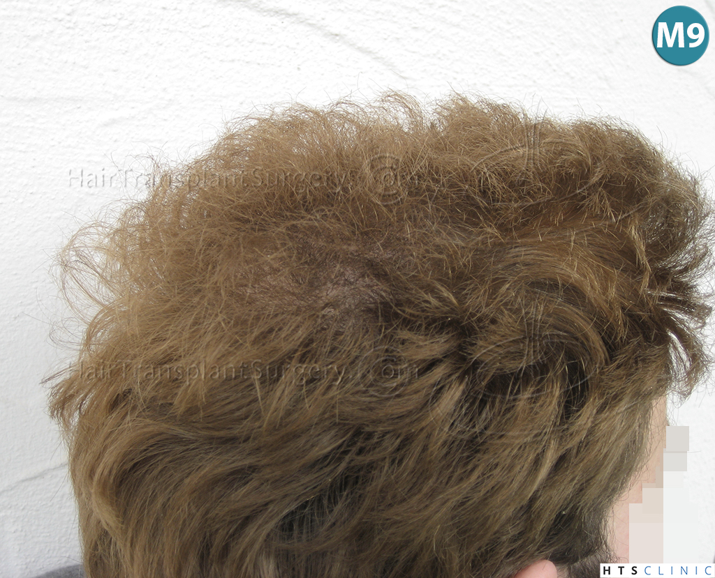 Dr.Devroye-HTS-Clinic-3856-FUT-NW-IV-23.jpg