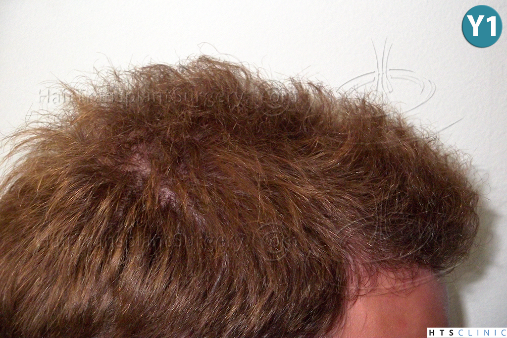 Dr.Devroye-HTS-Clinic-3856-FUT-NW-IV-26.jpg