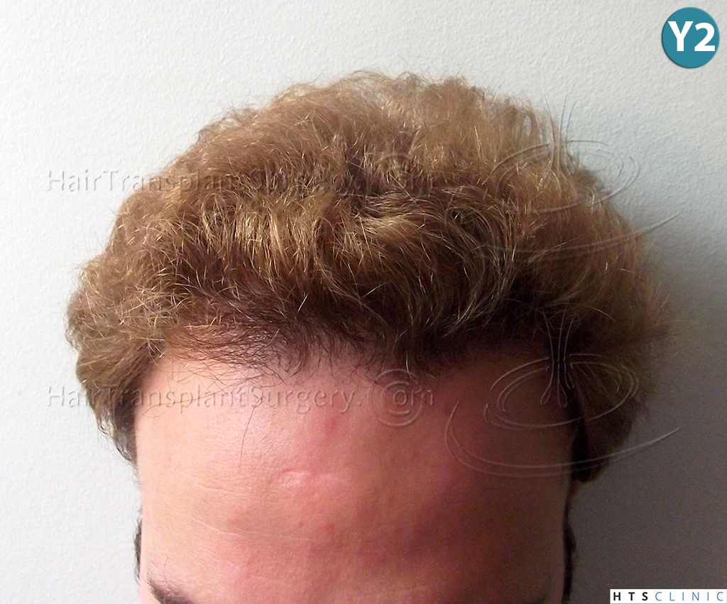 Dr.Devroye-HTS-Clinic-3856-FUT-NW-IV-28.jpg