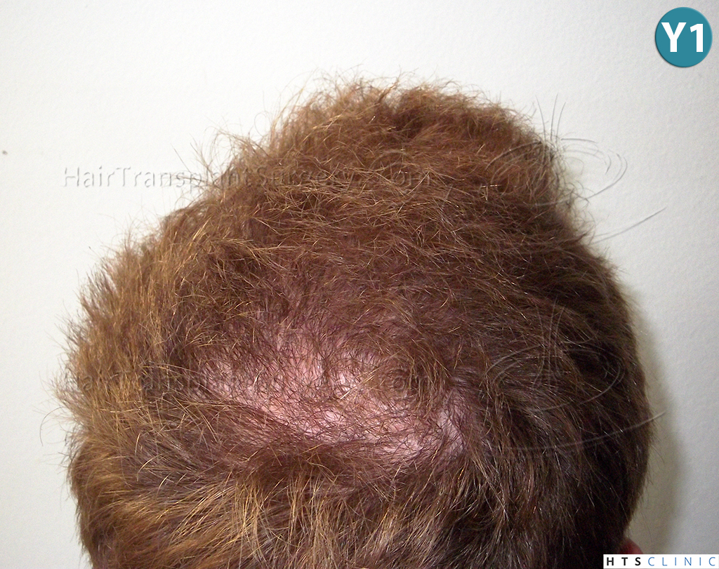Dr.Devroye-HTS-Clinic-3856-FUT-NW-IV-27.jpg