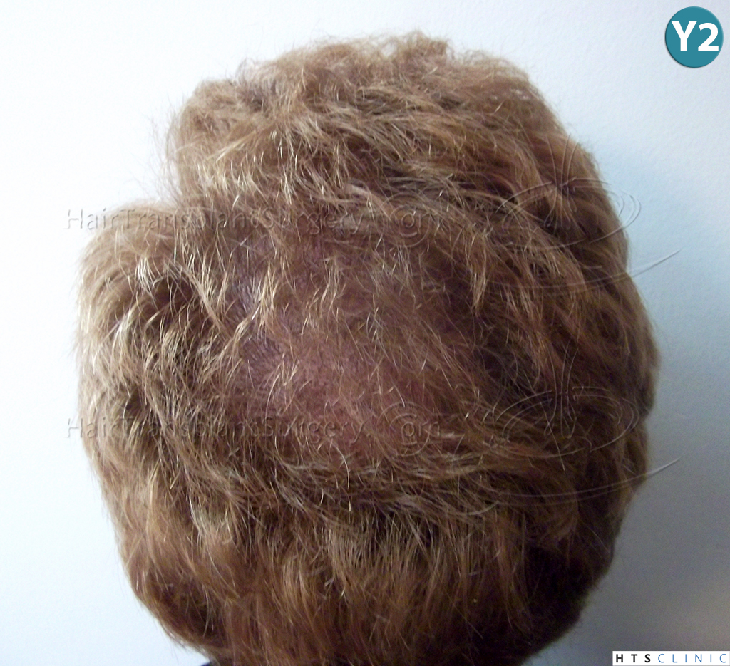 Dr.Devroye-HTS-Clinic-3856-FUT-NW-IV-31.jpg
