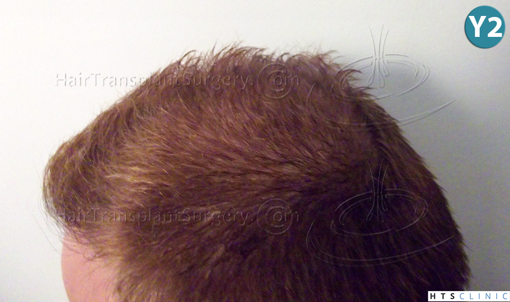 Dr.Devroye-HTS-Clinic-3856-FUT-NW-IV-33.jpg