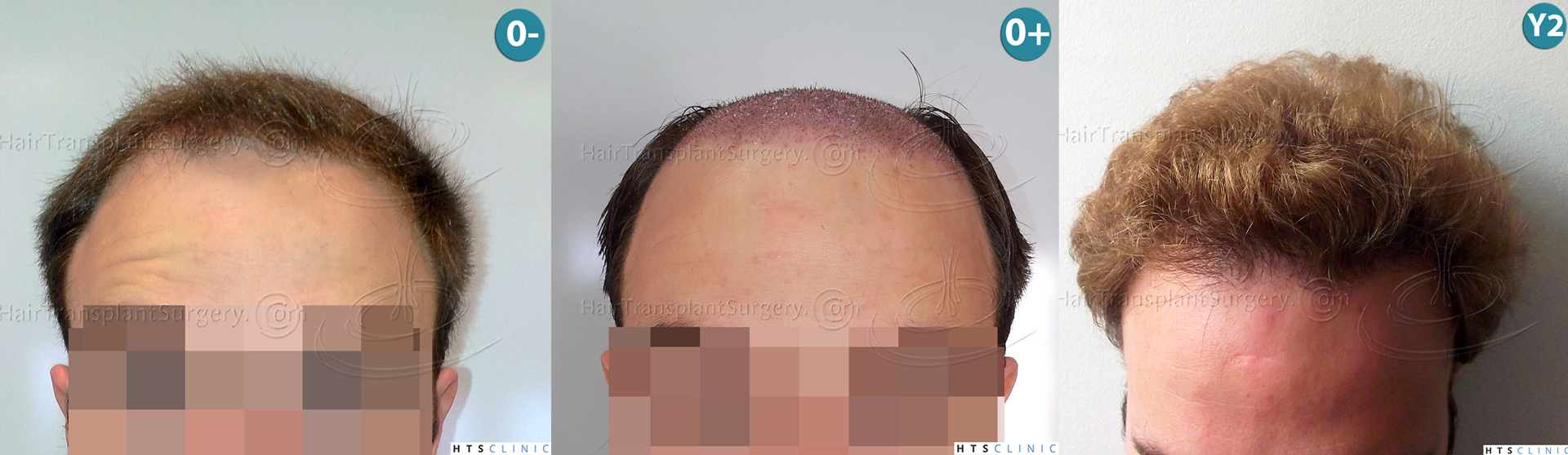 Dr.Devroye-HTS-Clinic-3856-FUT-NW-IV-Montage1.jpg