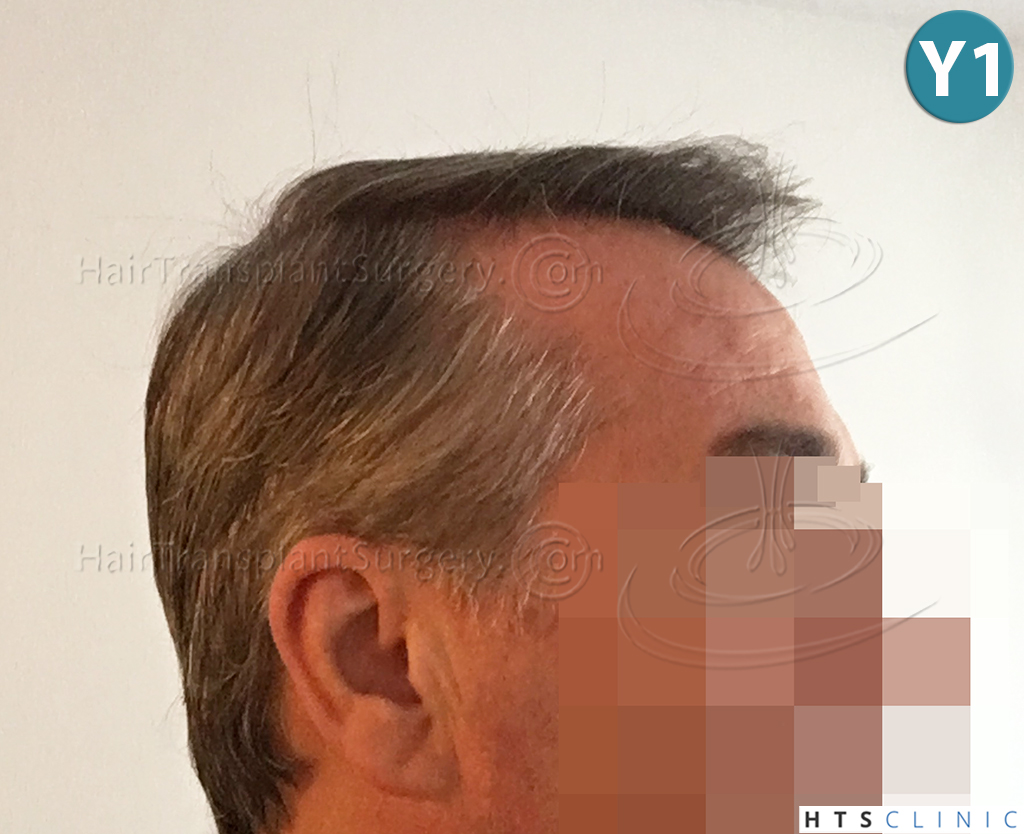 Dr.Devroye-HTS-Clinic-3627-FUT-Repair-NW-V-17.jpg
