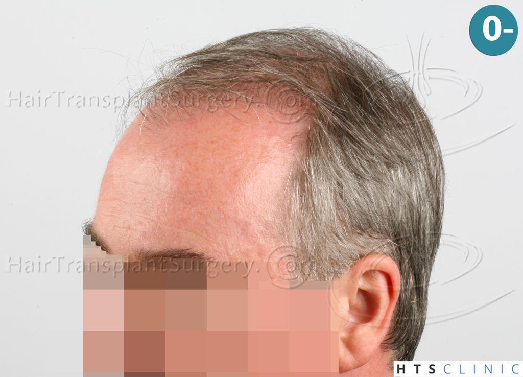 Dr.Devroye-HTS-Clinic-3627-FUT-Repair-NW-V-3.jpg