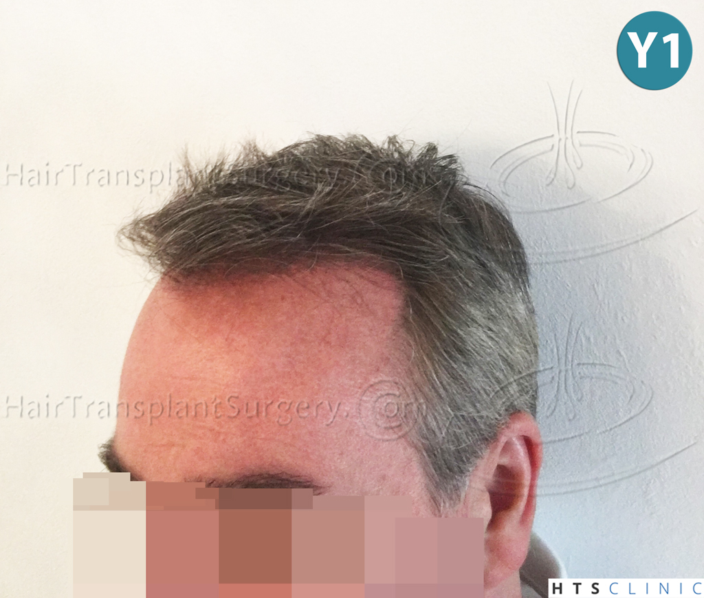 Dr.Devroye-HTS-Clinic-3627-FUT-Repair-NW-V-16.jpg