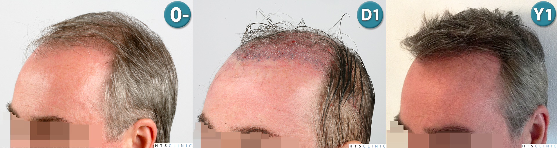 Dr.Devroye-HTS-Clinic-3627-FUT-Repair-NW-V-Montage2b.jpg