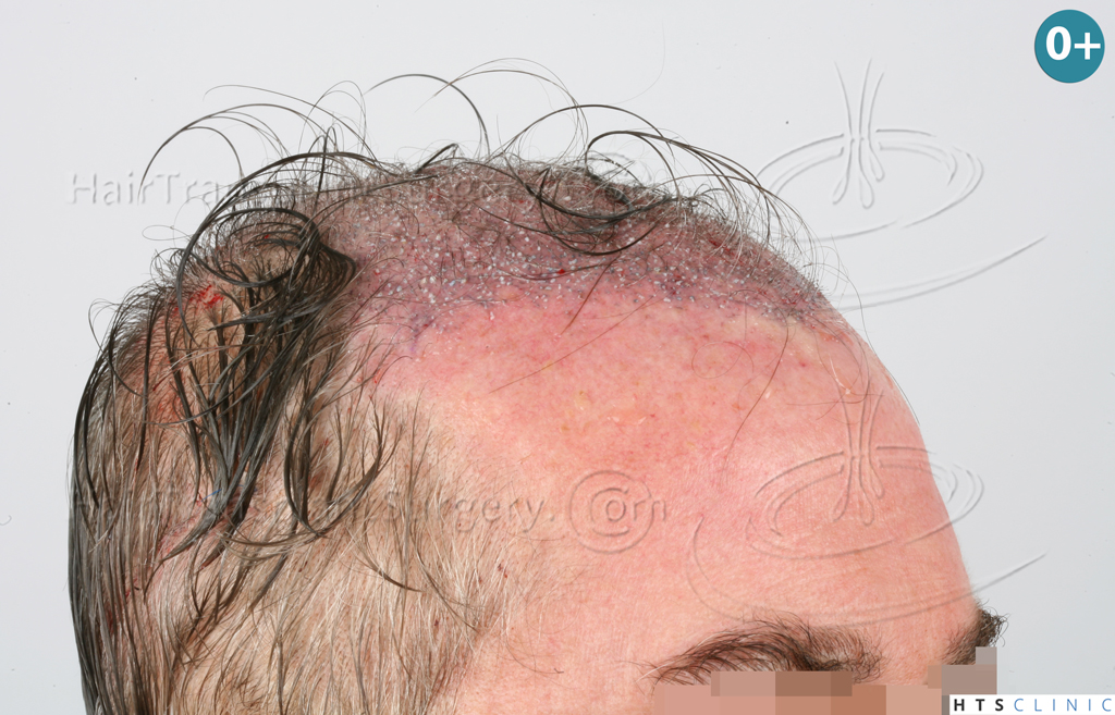 Dr.Devroye-HTS-Clinic-3627-FUT-Repair-NW-V-10.jpg