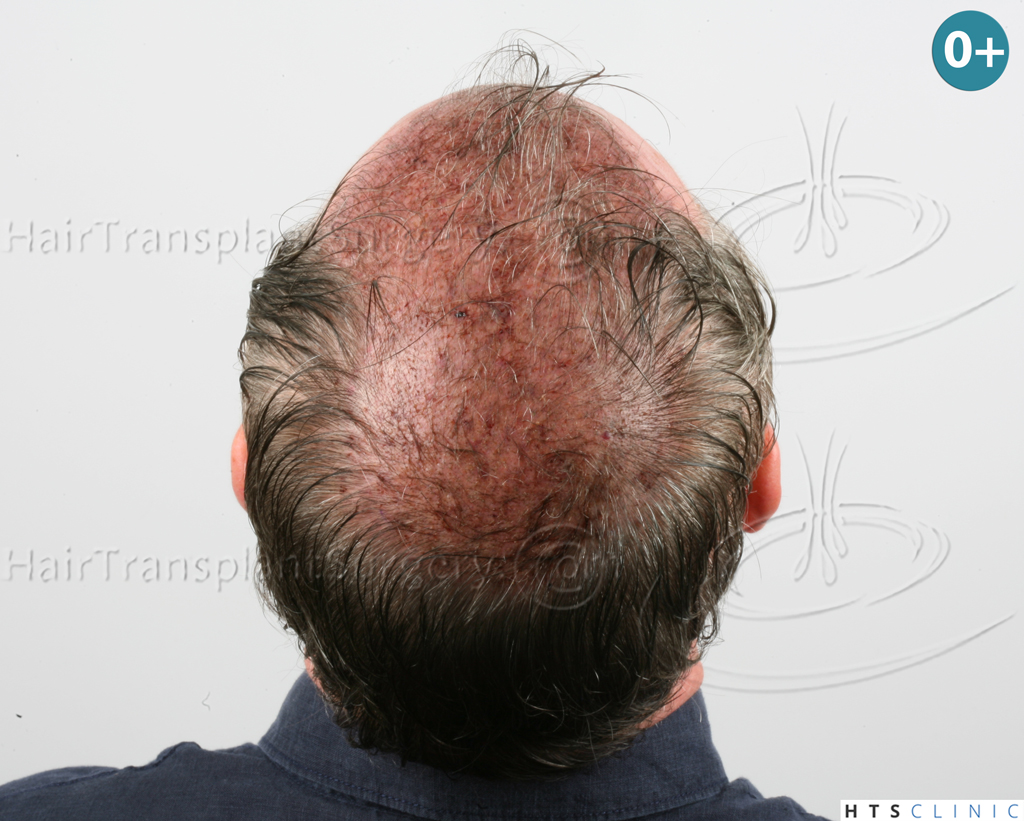 Dr.Devroye-HTS-Clinic-3627-FUT-Repair-NW-V-12.jpg