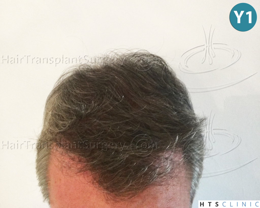 Dr.Devroye-HTS-Clinic-3627-FUT-Repair-NW-V-15.jpg