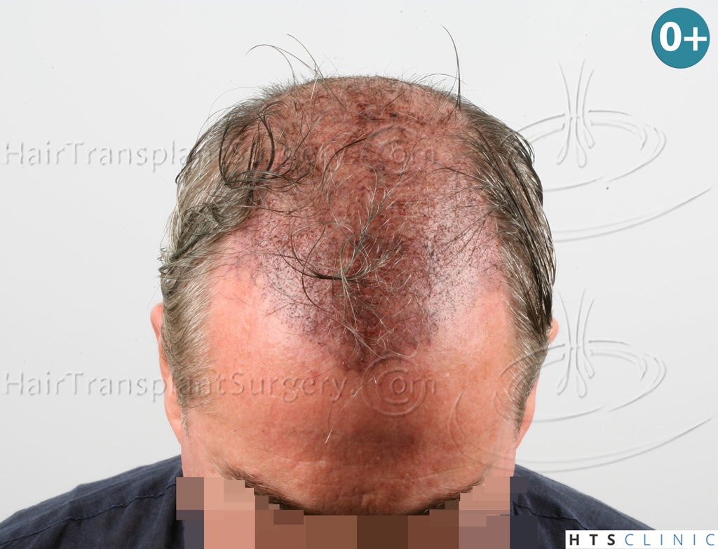 Dr.Devroye-HTS-Clinic-3627-FUT-Repair-NW-V-8.jpg