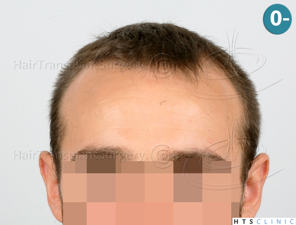 Dr.Devroye-HTS-Clinic-2203-FUE-NW-III-1.jpg