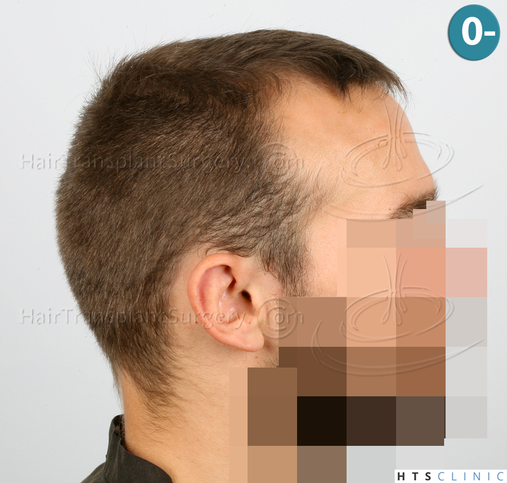 Dr.Devroye-HTS-Clinic-2203-FUE-NW-III-4.jpg