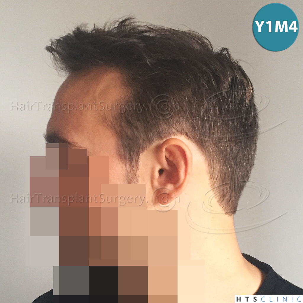Dr.Devroye-HTS-Clinic-2203-FUE-NW-III-25.jpg