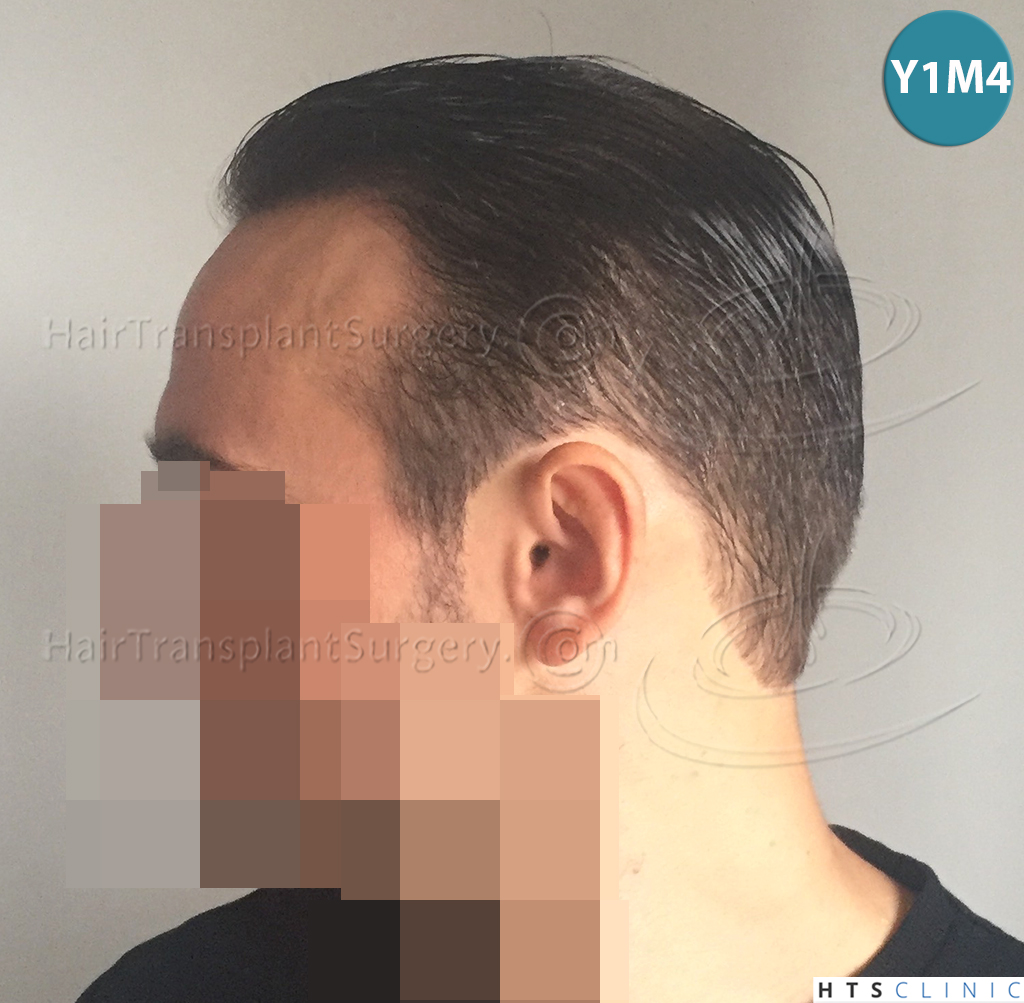 Dr.Devroye-HTS-Clinic-2203-FUE-NW-III-26.jpg
