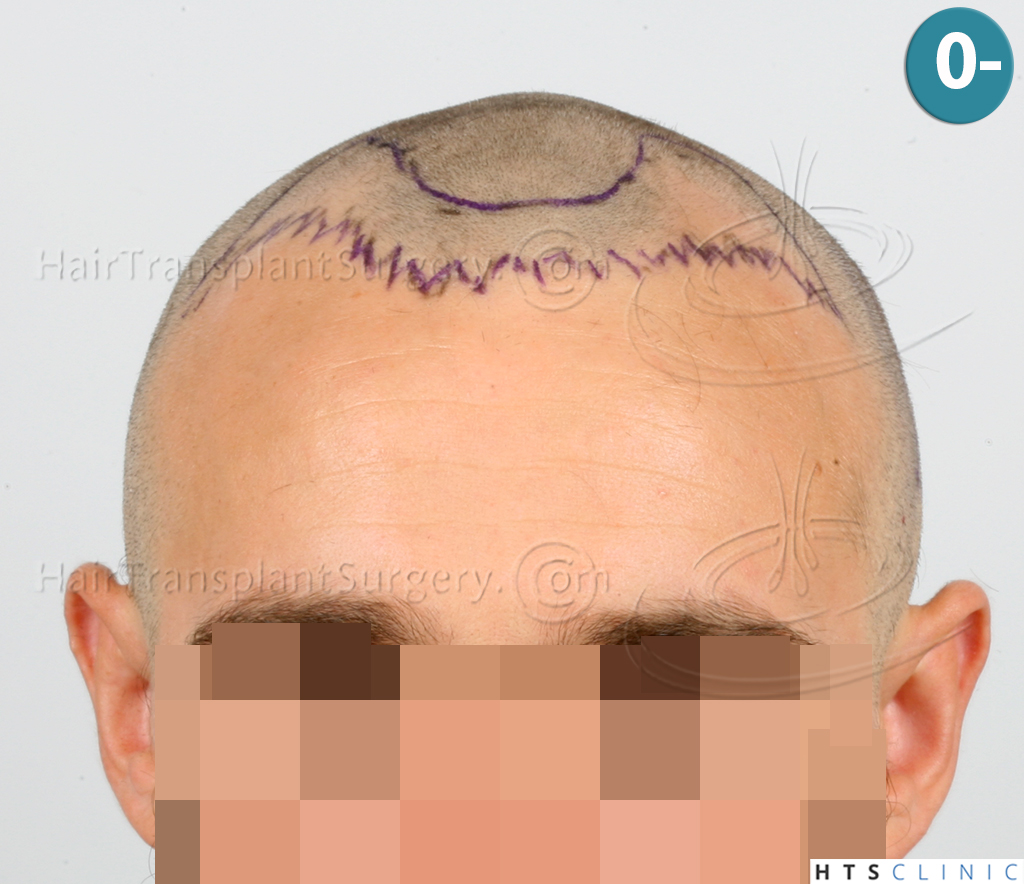 Dr.Devroye-HTS-Clinic-2203-FUE-NW-III-7.jpg
