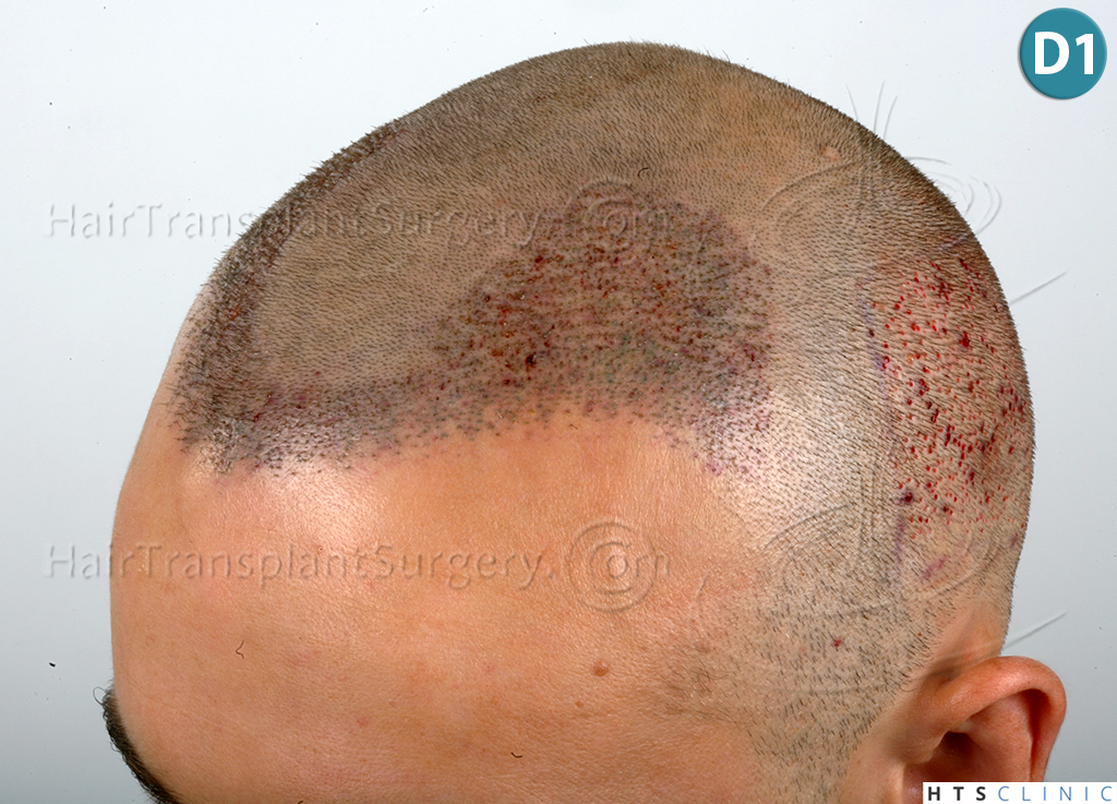 Dr.Devroye-HTS-Clinic-2203-FUE-NW-III-14.jpg