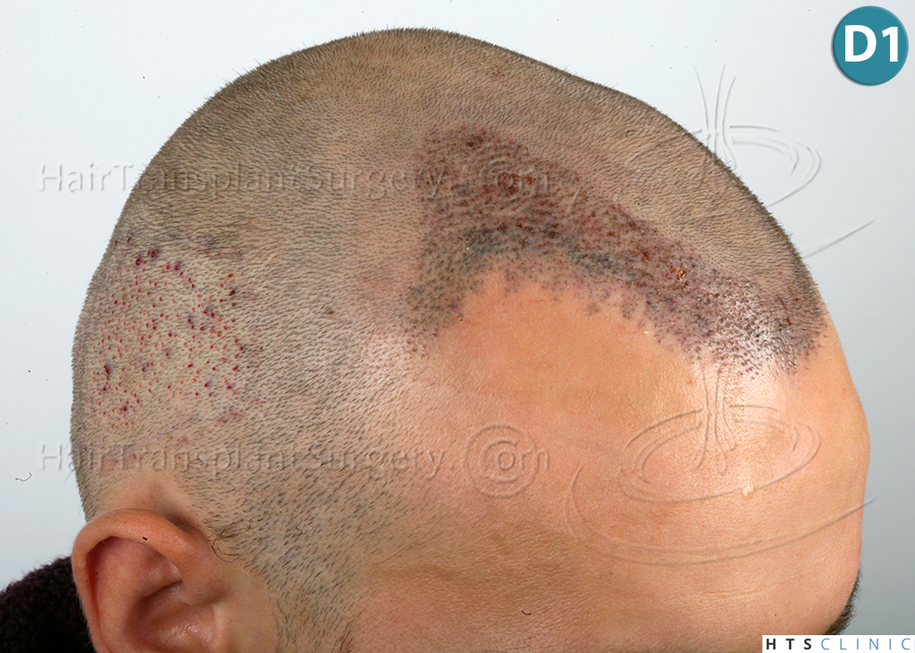 Dr.Devroye-HTS-Clinic-2203-FUE-NW-III-15.jpg