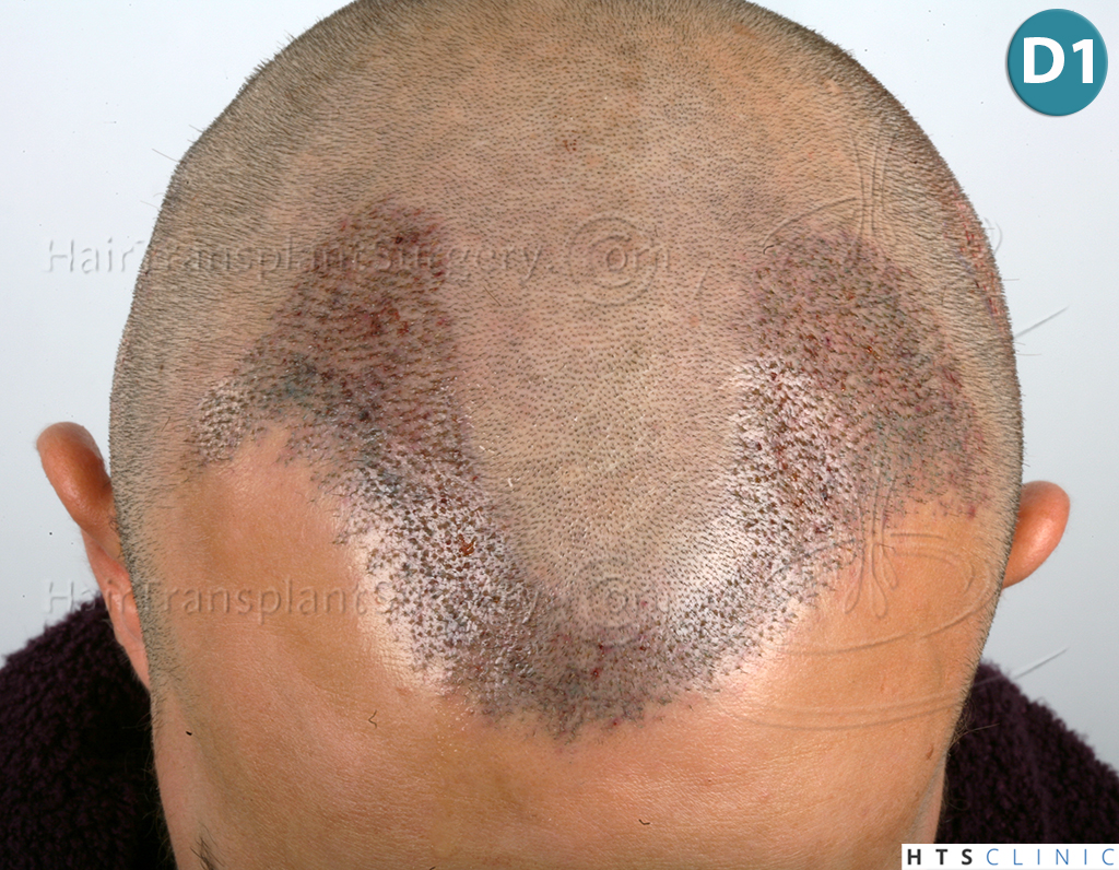 Dr.Devroye-HTS-Clinic-2203-FUE-NW-III-13.jpg