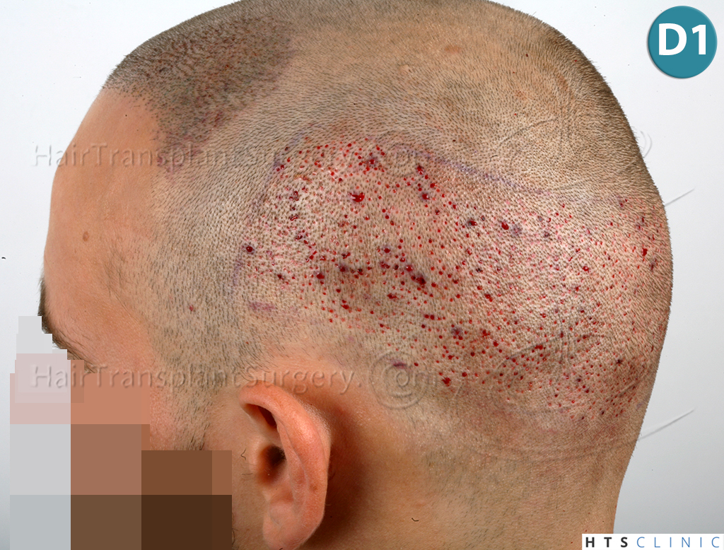Dr.Devroye-HTS-Clinic-2203-FUE-NW-III-17.jpg