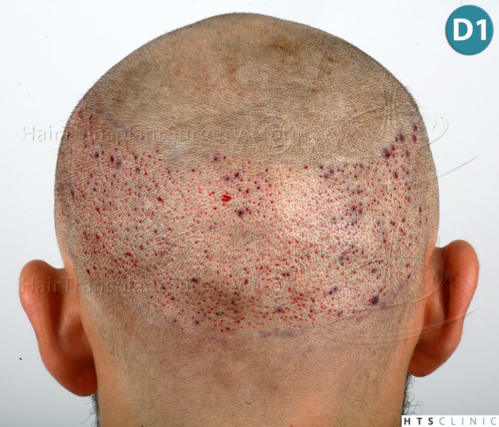 Dr.Devroye-HTS-Clinic-2203-FUE-NW-III-16.jpg