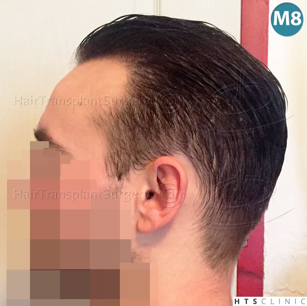 Dr.Devroye-HTS-Clinic-2203-FUE-NW-III-20.jpg