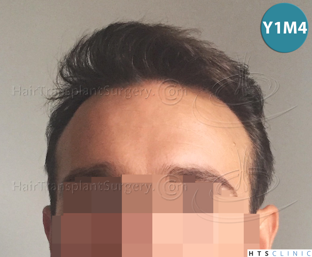 Dr.Devroye-HTS-Clinic-2203-FUE-NW-III-23.jpg