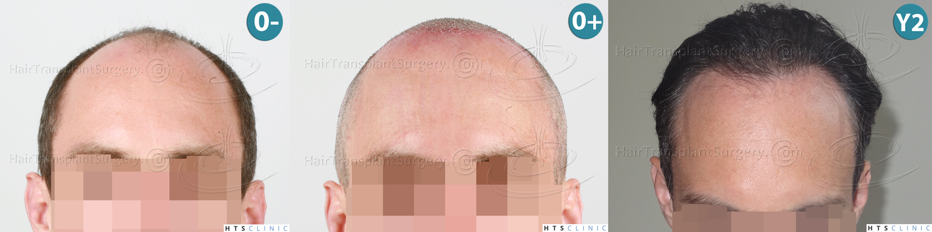 Dr.Devroye-HTS-clinic-3178-FUE-NW-VI-Montage1.jpg