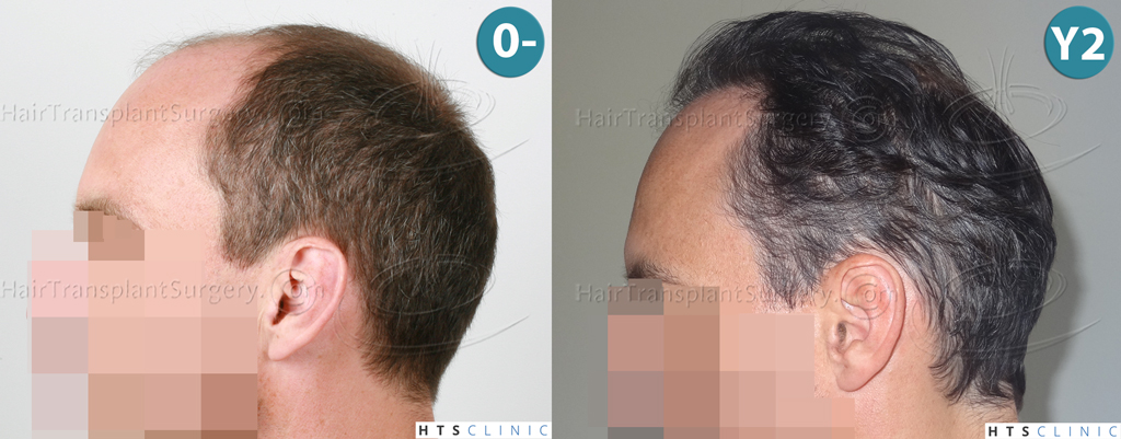 Dr.Devroye-HTS-clinic-3178-FUE-NW-VI-Montage2.jpg