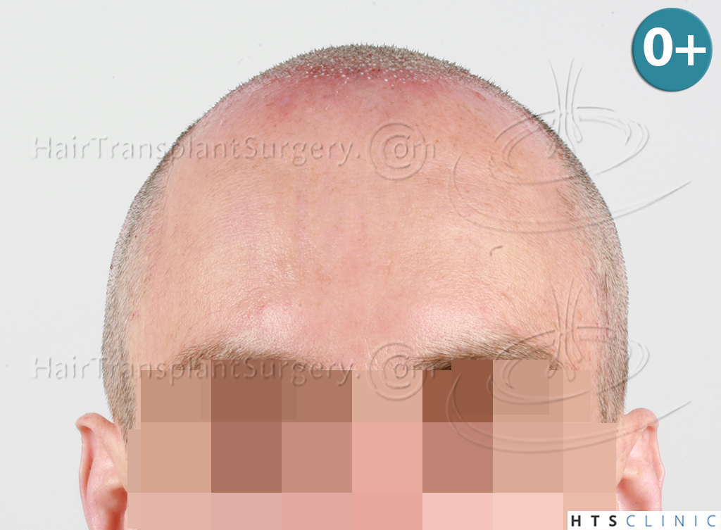 Dr.Devroye-HTS-clinic-3178-FUE-NW-VI-7.jpg