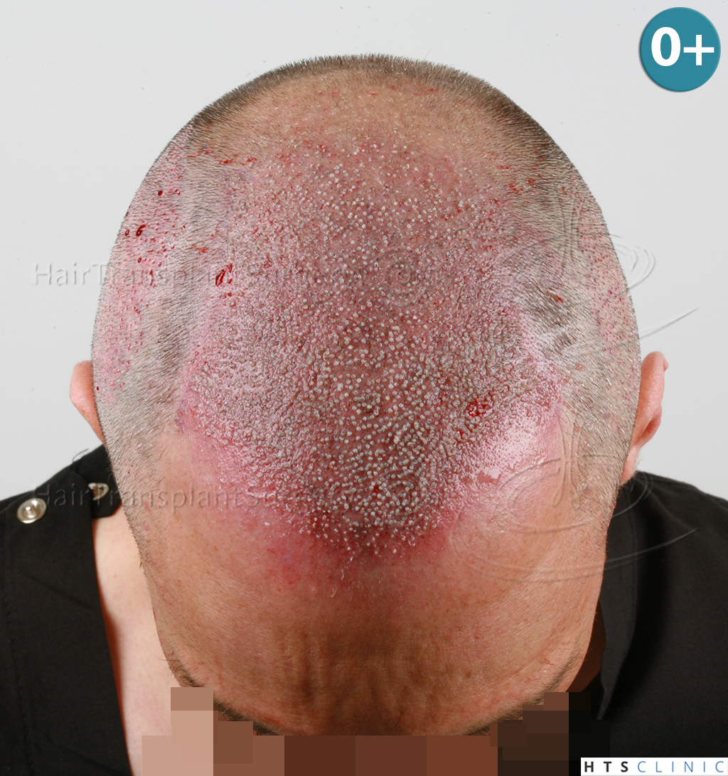 Dr.Devroye-HTS-clinic-3178-FUE-NW-VI-8.jpg