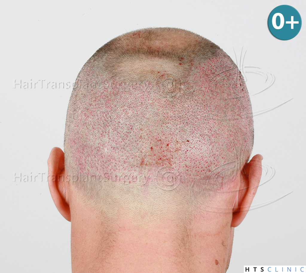 Dr.Devroye-HTS-clinic-3178-FUE-NW-VI-11.jpg