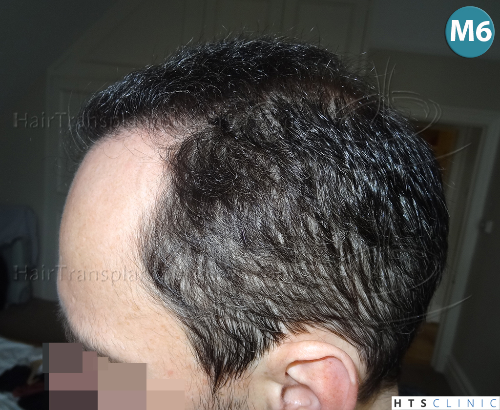 Dr.Devroye-HTS-clinic-3178-FUE-NW-VI-14.jpg