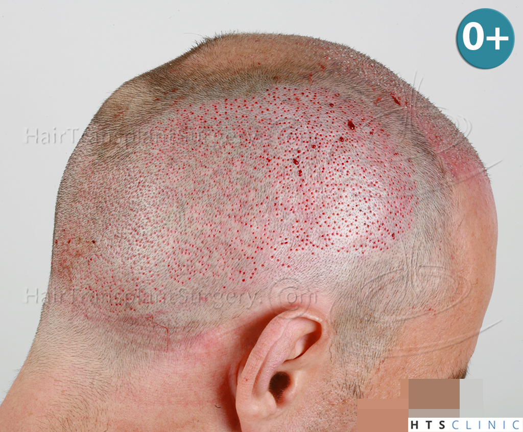 Dr.Devroye-HTS-clinic-3178-FUE-NW-VI-10.jpg