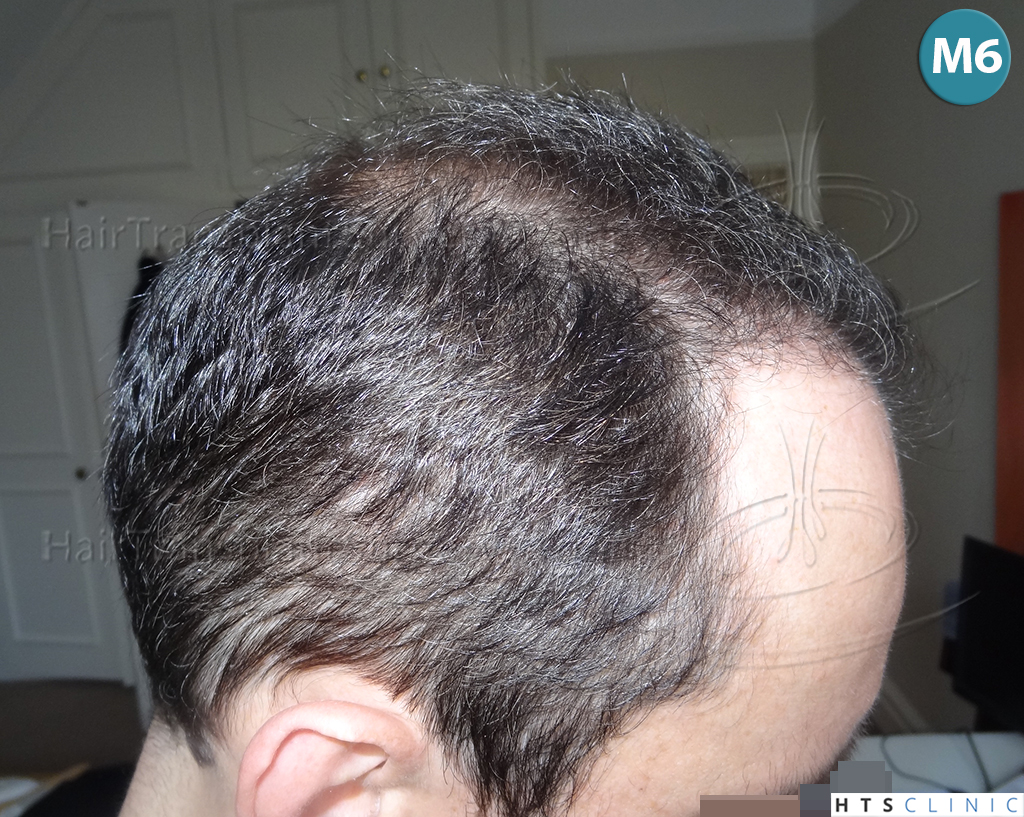 Dr.Devroye-HTS-clinic-3178-FUE-NW-VI-15.jpg