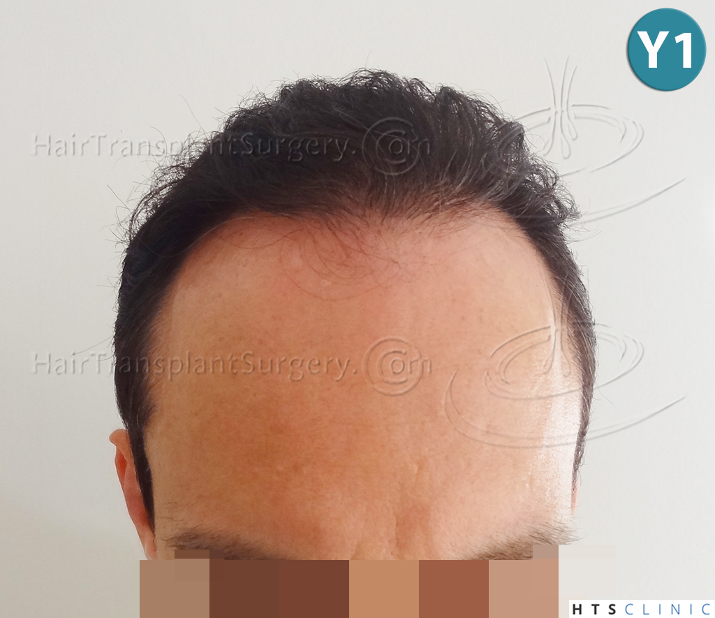 Dr.Devroye-HTS-clinic-3178-FUE-NW-VI-16.jpg